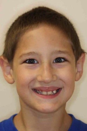 Boy with crooked teeth before braces