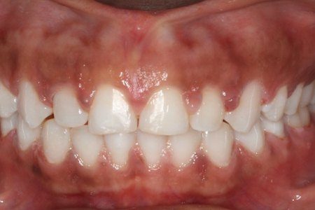 Closeup of smile with aligned teeth after braces