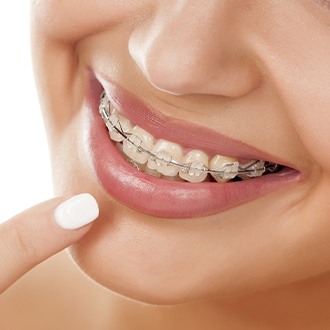 Woman pointing to clear and ceramic braces on teeth