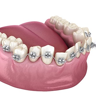 3D illustration of traditional braces ?