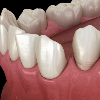 Illustration of gapped teeth
