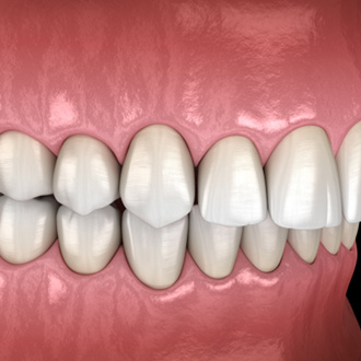 Illustration of an overbite