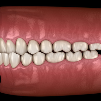 Illustration of an underbite