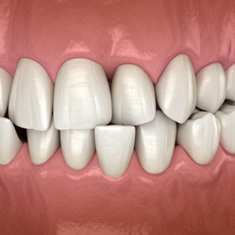 Illustration of a crossbite