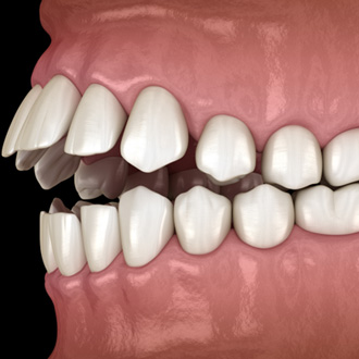 Illustration of an open bite