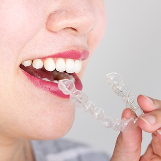 Closeup of patient placing Invisalign tray