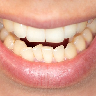 Closeup of mouth with crowded teeth before Hopkinton orthodontist