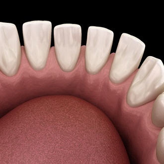 Diagram of gapped teeth before correction from Hopkinton orthodontist