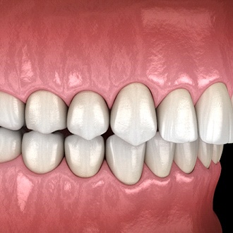 Diagram of overbite in Hopkinton before orthodontic treatment