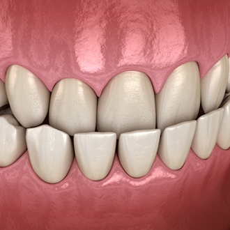 Diagram of underbite in Hopkinton before orthodontics