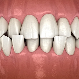 Diagram of crossbite crooked teeth before Hopkinton orthodontist