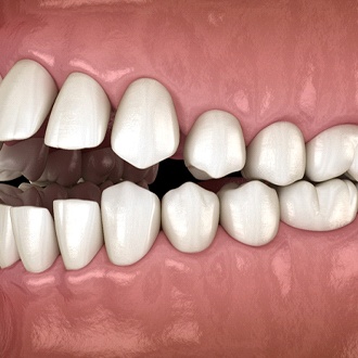 Diagram of open bite in Hopkinton before orthodontic treatment