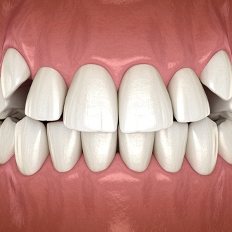 Diagram of impacted canines prior to Hopkinton orthodontist treatment