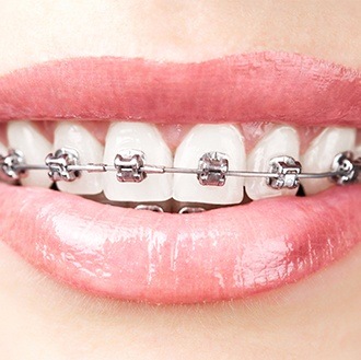 Closeup of smile with self ligating braces