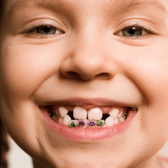 Child's smile with pediatric orthodontics appliance in place