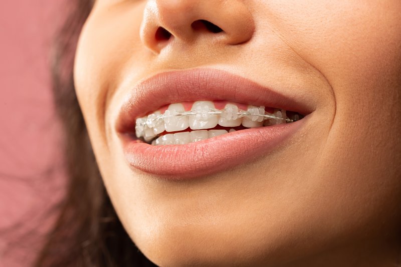 Closeup of woman smiling with braces