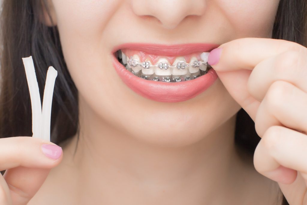 Woman with braces placing dental wax on bracket