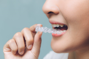 closeup of a patient with Invisalign 